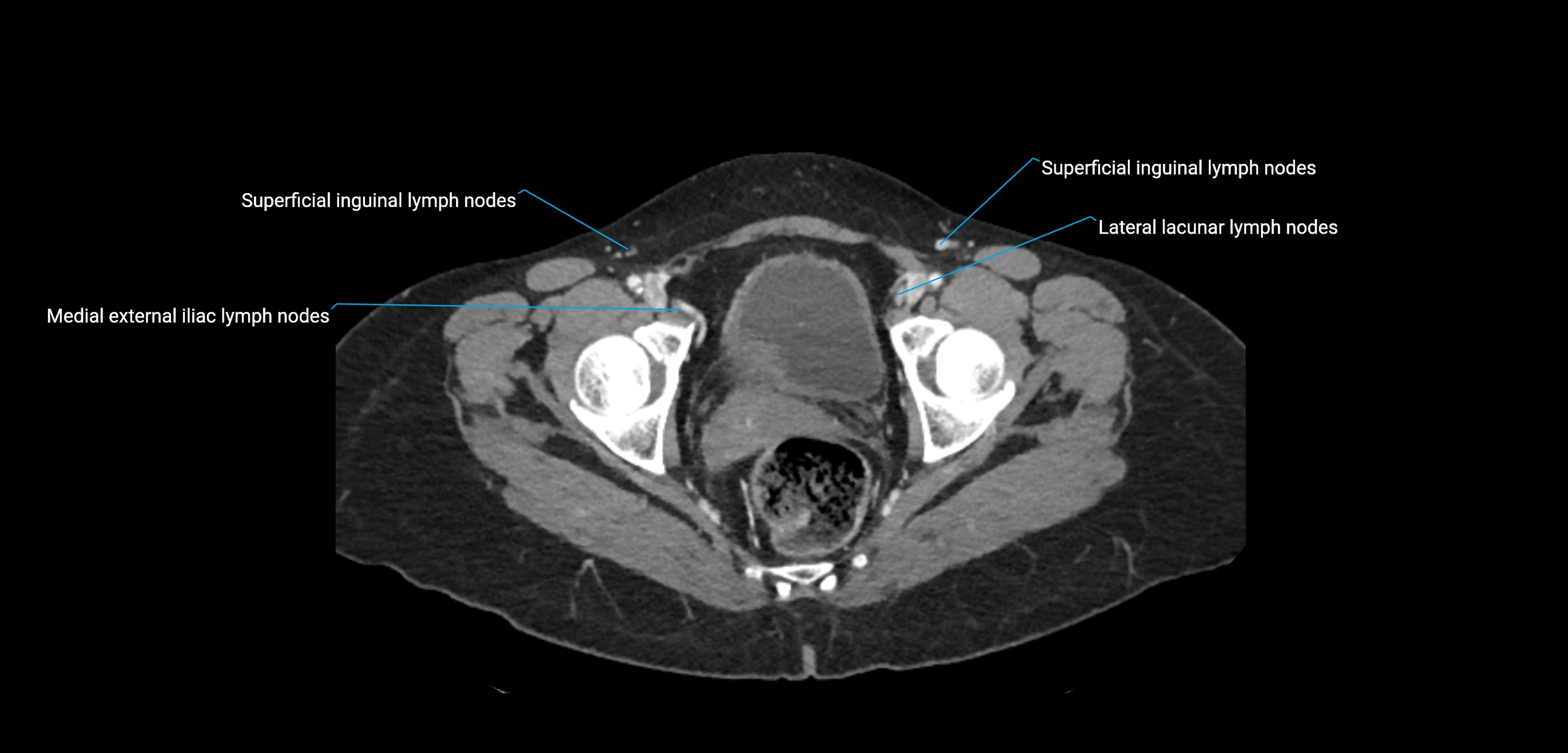 CT ct abdominal lymph nodes  axial cross sectional anatomy  enchanced radiology image -img-00002-00385.webp